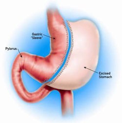 Gastric Sleeve