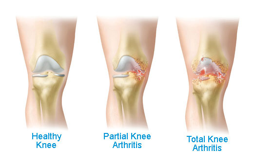 Healthy Knee vs. Partial Knee Arthritis vs. Total Knee Arthritis