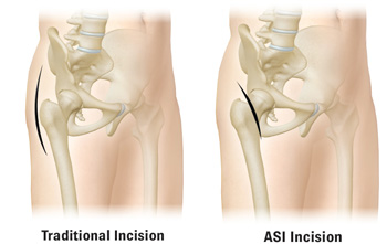 Traditional Incision v ASI Incision