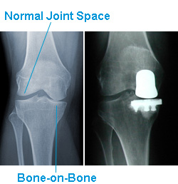 Normal Joint Space vs Bone-on-Bone