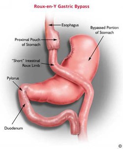 Bariatric GB